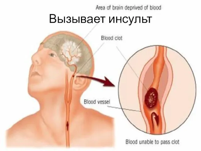 Вызывает инсульт