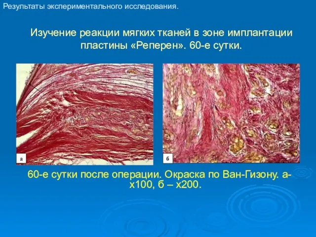 Изучение реакции мягких тканей в зоне имплантации пластины «Реперен». 60-е сутки. 60-е