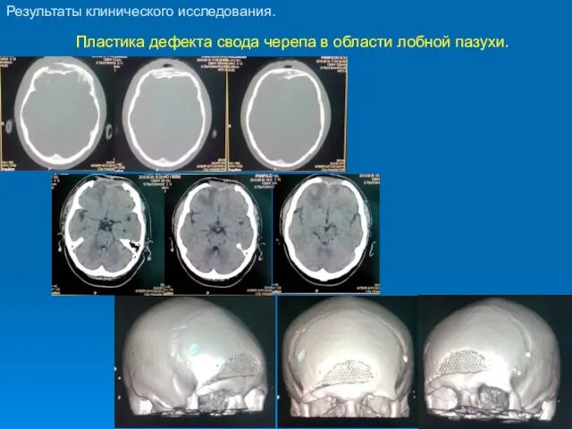 Пластика дефекта свода черепа в области лобной пазухи. Результаты клинического исследования.