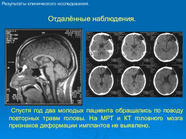 Отдалённые наблюдения. Спустя год два молодых пациента обращались по поводу повторных травм