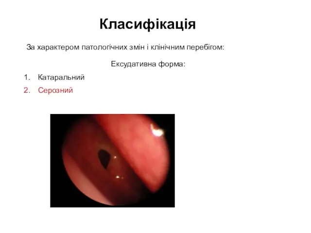 Класифікація Ексудативна форма: Катаральний Серозний За характером патологічних змін і клінічним перебігом: