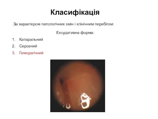 Класифікація Ексудативна форма: Катаральний Серозний Геморагічний За характером патологічних змін і клінічним перебігом: