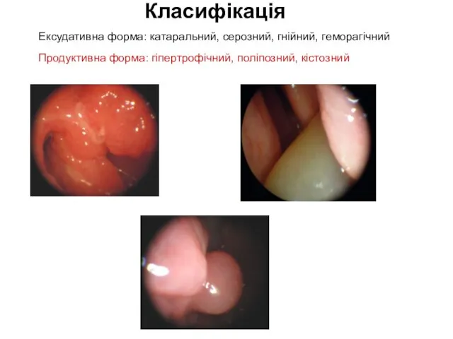 Класифікація Ексудативна форма: катаральний, серозний, гнійний, геморагічний Продуктивна форма: гіпертрофічний, поліпозний, кістозний