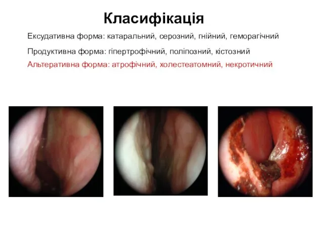 Класифікація Ексудативна форма: катаральний, серозний, гнійний, геморагічний Продуктивна форма: гіпертрофічний, поліпозний, кістозний