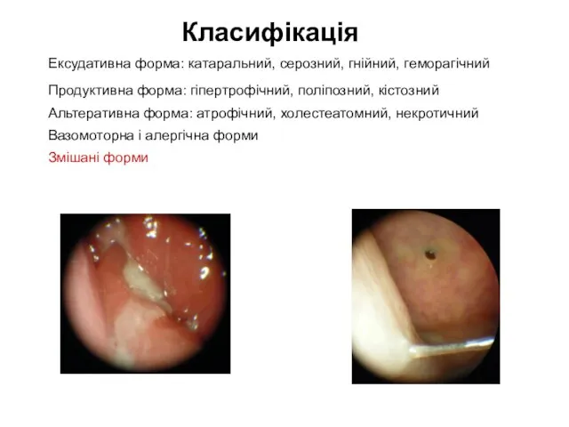 Класифікація Ексудативна форма: катаральний, серозний, гнійний, геморагічний Продуктивна форма: гіпертрофічний, поліпозний, кістозний