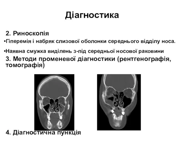 Діагностика 2. Риноскопія Гіперемія і набряк слизової оболонки середнього відділу носа. Наявна