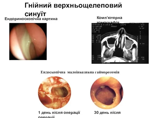 Гнійний верхньощелеповий синуїт Комп’ютерна томографія Ендоскопічна малоінвазивна гайморотомія 1 день після операції