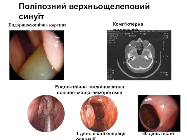 Комп’ютерна томографія Ендоскопічна малоінвазивна поліпоетмоїдогайморотомія Ендориноскопічна картина 1 день після операції 30