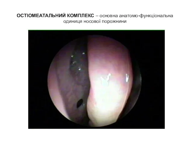 ОСТІОМЕАТАЛЬНИЙ КОМПЛЕКС – основна анатомо-функціональна одиниця носової порожнини