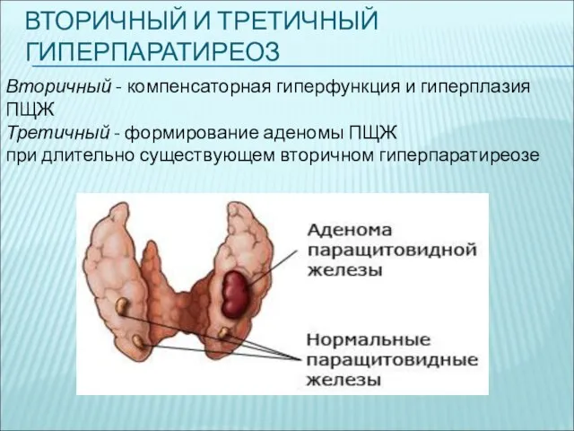 ВТОРИЧНЫЙ И ТРЕТИЧНЫЙ ГИПЕРПАРАТИРЕОЗ Вторичный - компенсаторная гиперфункция и гиперплазия ПЩЖ Третичный