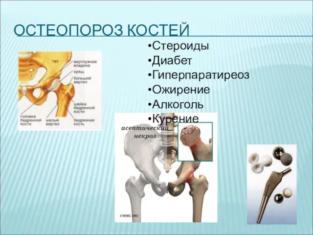 ОСТЕОПОРОЗ КОСТЕЙ Стероиды Диабет Гиперпаратиреоз Ожирение Алкоголь Курение