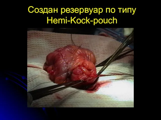 Создан резервуар по типу Hemi-Kock-pouch