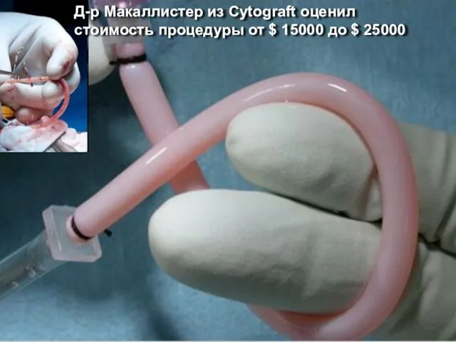 Д-р Макаллистер из Cytograft оценил стоимость процедуры от $ 15000 до $ 25000