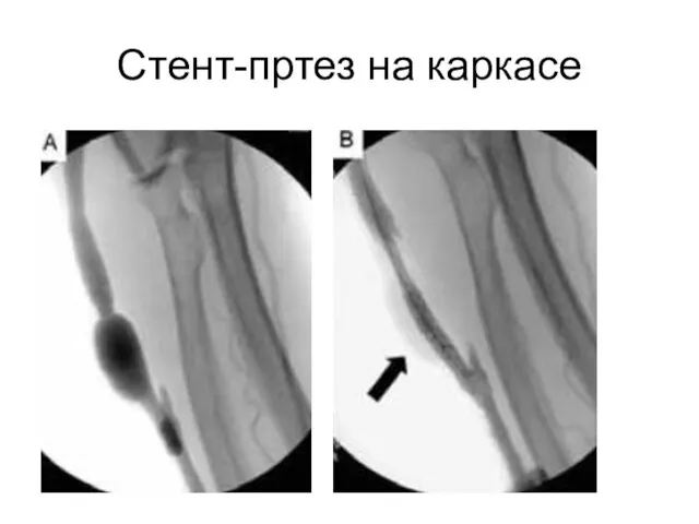 Стент-пртез на каркасе