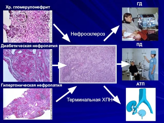 Хр. гломерулонефрит Диабетическая нефропатия Гипертоническая нефропатия АТП ПД ГД Нефросклероз Терминальная ХПН