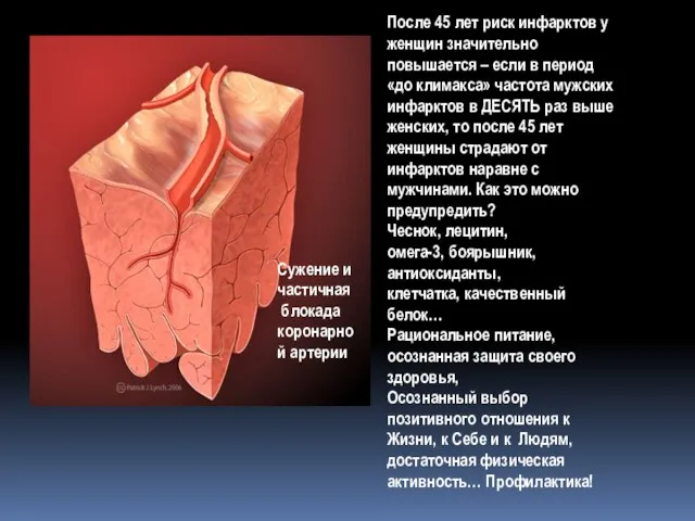 Сужение и частичная блокада коронарной артерии После 45 лет риск инфарктов у