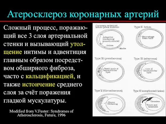 Атеросклероз коронарных артерий Сложный процесс, поражаю-щий все 3 слоя артериальной стенки и