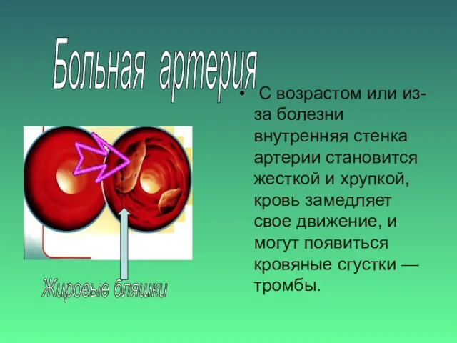 С возрастом или из-за болезни внутренняя стенка артерии становится жесткой и хрупкой,