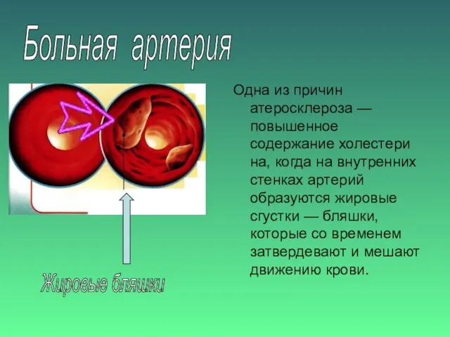 Больная артерия Одна из причин атеросклероза — повышенное содержание холестери­на, когда на