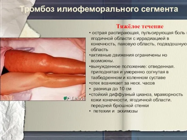 Тромбоз илиофеморального сегмента Тяжёлое течение острая распирающая, пульсирующая боль в ягодичной области