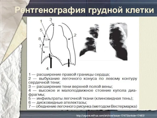 Рентгенография грудной клетки http://urgent.mif-ua.com/archive/issue-17473/article-17483/