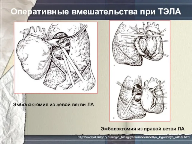 Оперативные вмешательства при ТЭЛА Эмболэктомия из левой ветви ЛА Эмболэктомия из правой ветви ЛА http://www.allsurgery.ru/angio_hirurgiya/tromboemboliya_legochnyh_arterii.html