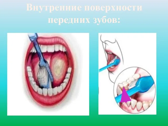 Внутренние поверхности передних зубов: