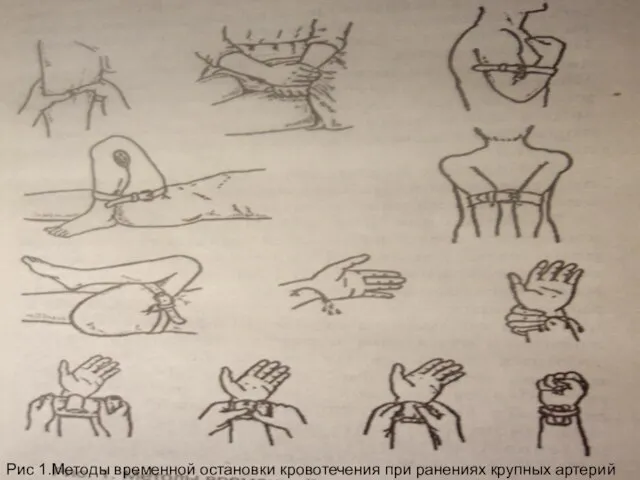 Рис 1.Методы временной остановки кровотечения при ранениях крупных артерий