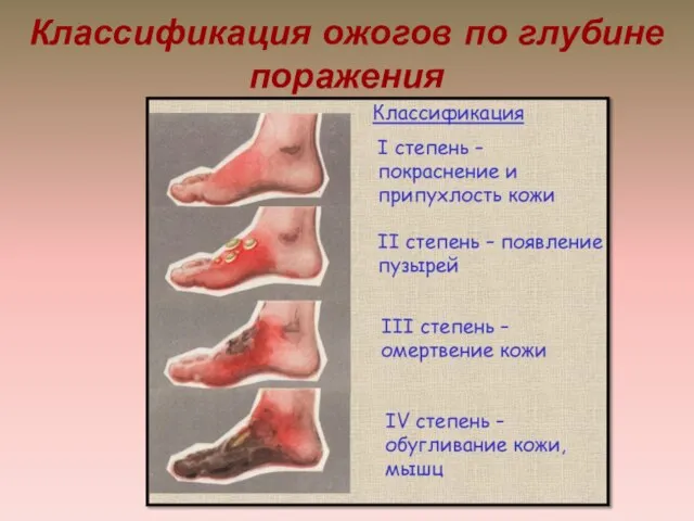 Классификация ожогов по глубине поражения