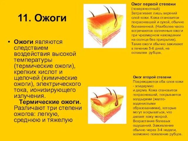 11. Ожоги Ожоги являются следствием воздействия высокой температуры (термические ожоги), крепких кислот