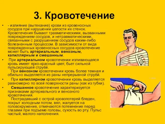 3. Кровотечение - излияние (вытекание) крови из кровеносных сосудов при нарушении целости