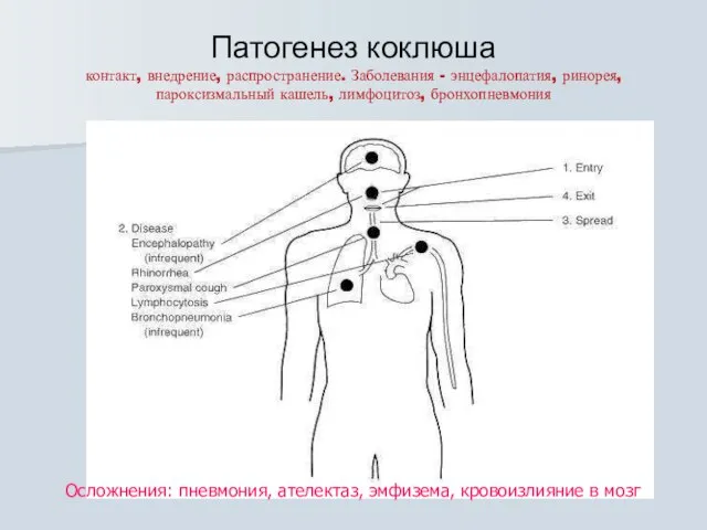 Патогенез коклюша контакт, внедрение, распространение. Заболевания - энцефалопатия, ринорея, пароксизмальный кашель, лимфоцитоз,