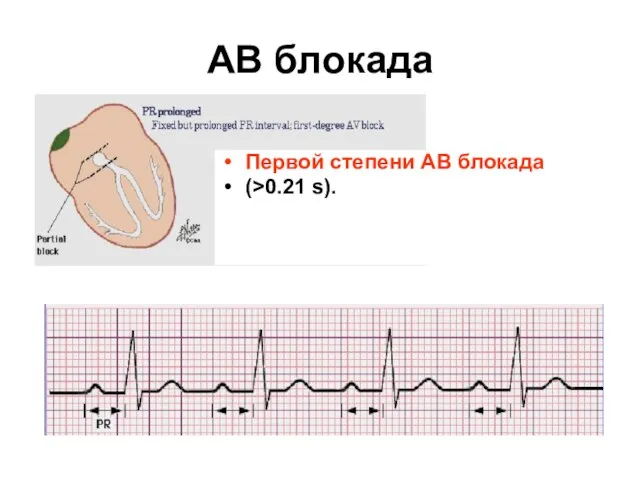 AВ блокада Первой степени АВ блокада (>0.21 s).