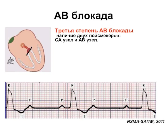 AВ блокада Третья степень АВ блокады наличие двух пейсмекеров: СА узел и АВ узел. NSMA-SAITM, 2011