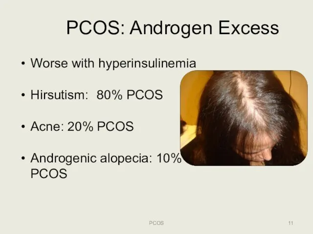 PCOS: Androgen Excess Worse with hyperinsulinemia Hirsutism: 80% PCOS Acne: 20% PCOS