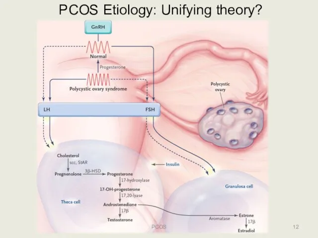 PCOS Etiology: Unifying theory? PCOS
