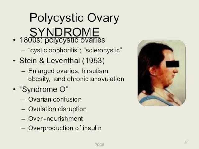 Polycystic Ovary SYNDROME 1800s: polycystic ovaries “cystic oophoritis”; “sclerocystic” Stein & Leventhal