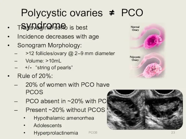 Polycystic ovaries ≠ PCO syndrome Transvaginal sono is best Incidence decreases with