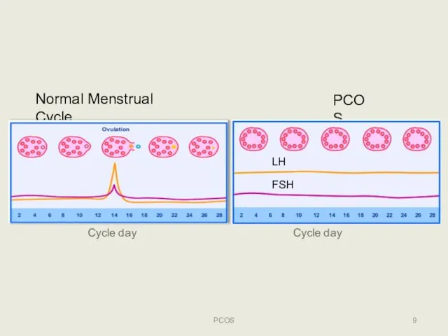Normal Menstrual Cycle PCOS LH FSH PCOS Cycle day Cycle day