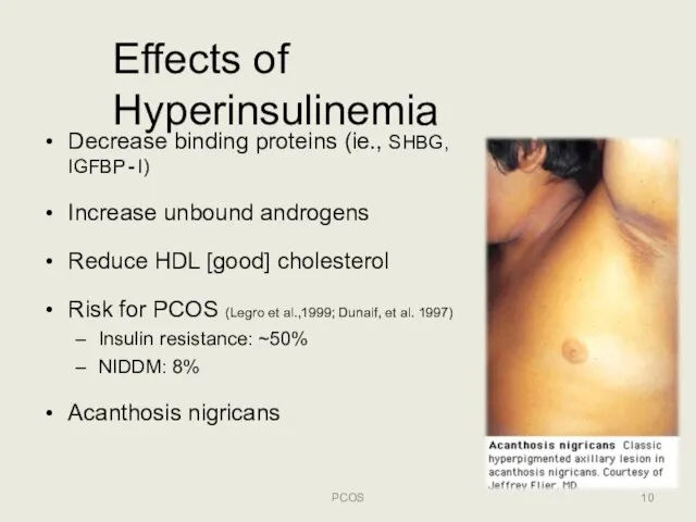 Effects of Hyperinsulinemia Decrease binding proteins (ie., SHBG, IGFBP‐I) Increase unbound androgens