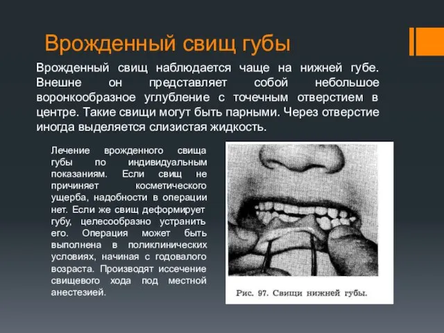 Врожденный свищ губы Врожденный свищ наблюдается чаще на нижней губе. Внешне он
