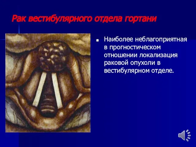 Рак вестибулярного отдела гортани Наиболее неблагоприятная в прогностическом отношении локализация раковой опухоли в вестибулярном отделе.