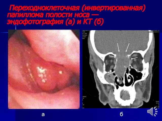 Переходноклеточная (инвертированная) папиллома полости носа — эндофотография (а) и КТ (б) а б