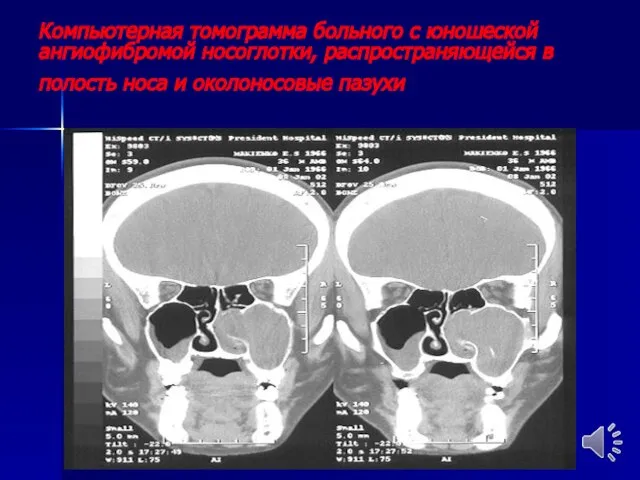 Компьютерная томограмма больного с юношеской ангиофибромой носоглотки, распространяющейся в полость носа и околоносовые пазухи