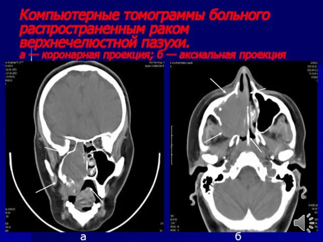 Компьютерные томограммы больного распространенным раком верхнечелюстной пазухи. а — коронарная проекция; б