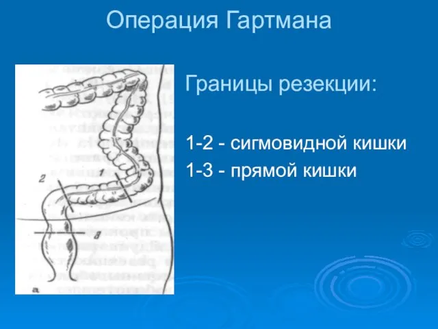 Операция Гартмана Границы резекции: 1-2 - сигмовидной кишки 1-3 - прямой кишки