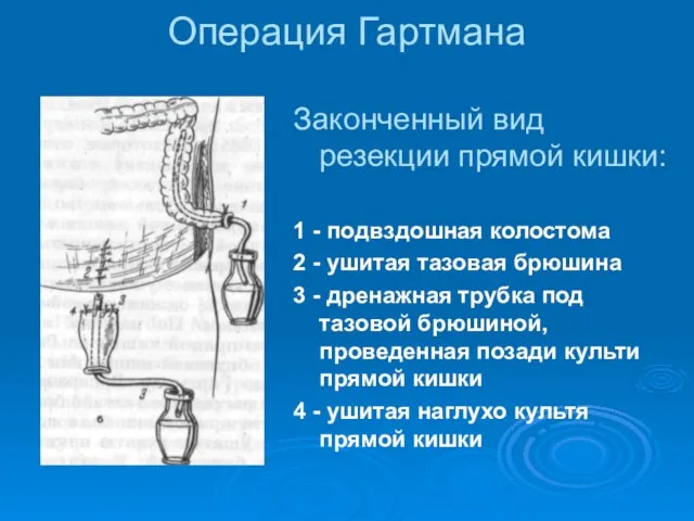 Операция Гартмана Законченный вид резекции прямой кишки: 1 - подвздошная колостома 2