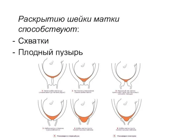 Раскрытию шейки матки способствуют: Схватки Плодный пузырь