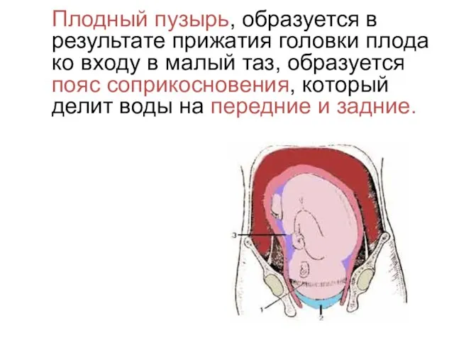 Плодный пузырь, образуется в результате прижатия головки плода ко входу в малый