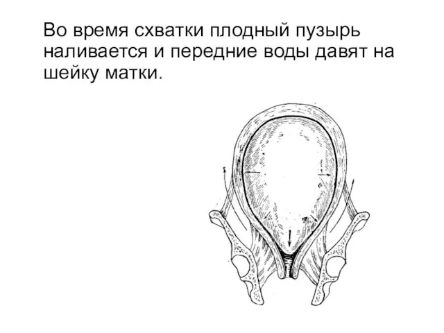 Во время схватки плодный пузырь наливается и передние воды давят на шейку матки.